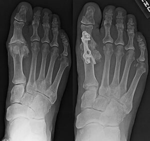 Arthritis of the Big Toe (Hallux Rigidus): What Are My Treatment ...