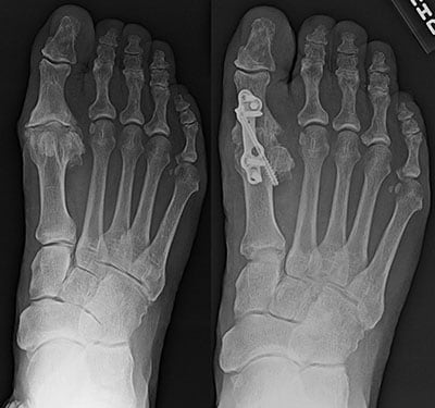 Arthritis Of The Big Toe (hallux Rigidus): What Are My Treatment 