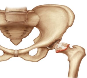 drawing a pelvis and femur showing arthritis in the hip