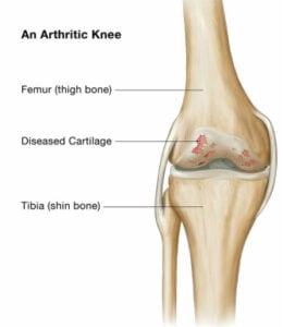 diagram of arthritic knee with parts labeled