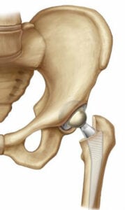 drawing of a pelvis and femur showing a hip replacement