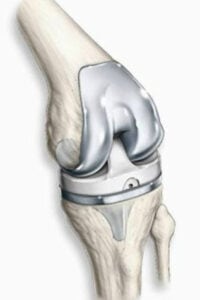 drawing of total knee replacement