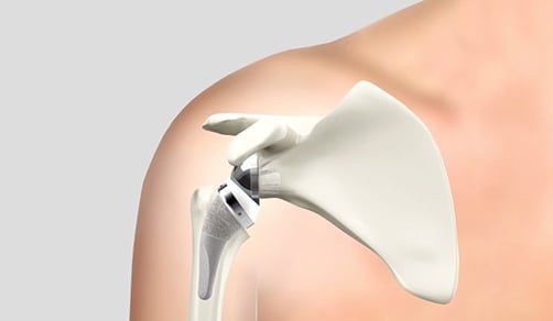 digital illustration showing a reverse shoulder replacement