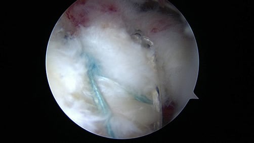 arthroscopic image showing rotator cuff repair