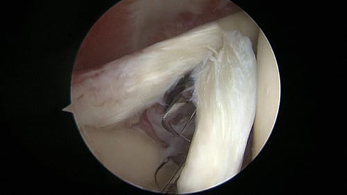 arthroscopic image of biceps tendon