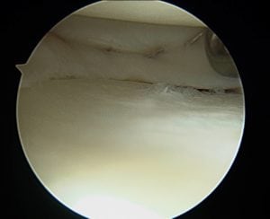 arthroscopic image of the inside of the knee