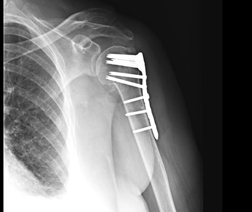 x-ray showing pins and metal plate along an upper arm bone