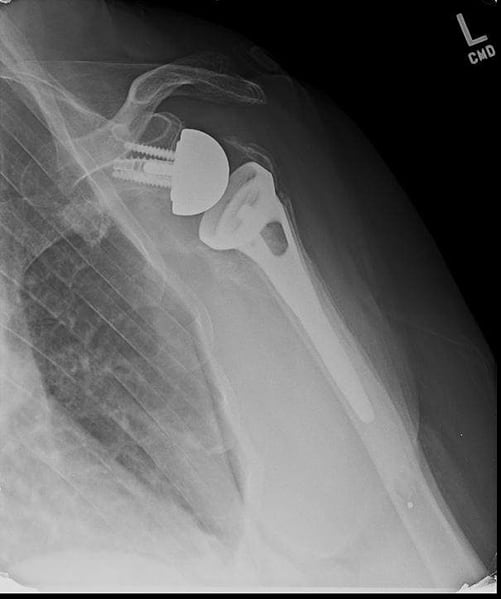 x-ray showing a reverse shoulder replacement