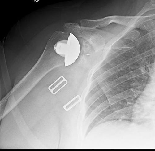 x-ray showing a shoulder replacement