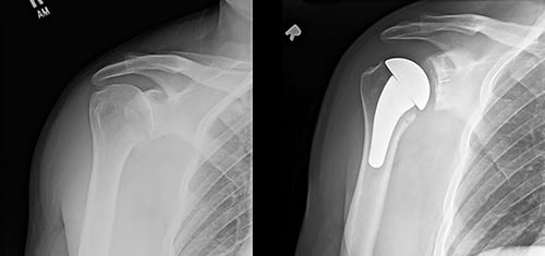 x-rays showing a shoulder without a shoulder replacement and with a shoulder replacement